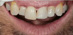 Dental fillings after