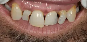 Dental filling before
