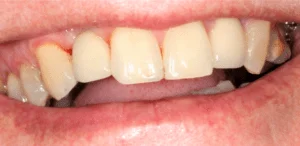 Teeth fixed from missing tooth