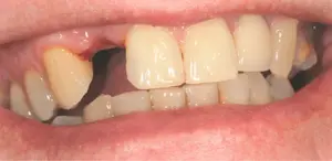 A missing tooth before